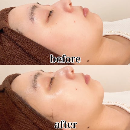 yuna** on LIPS 「エステサロンに行ってみた💨/施術・肌状態について詳しくレビュー..」(6枚目)