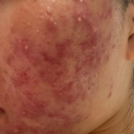 ハトムギ化粧水(ナチュリエ スキンコンディショナー R )/ナチュリエ/化粧水を使ったクチコミ(3枚目)