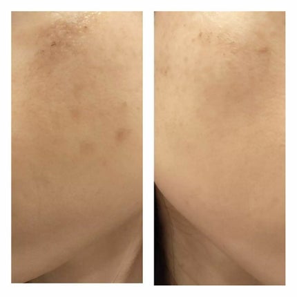 あにゃにゃ♡フォロバ100♡ on LIPS 「7回目のフォトシルクプラス後1週間の変化🙌※去年の8月から品川..」(8枚目)