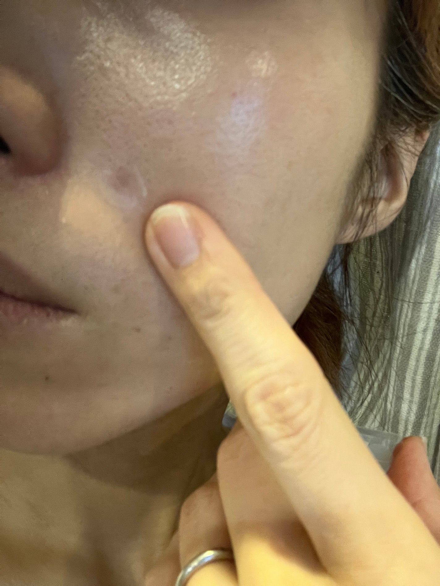 極薄透明パッチ nikipa!/金冠堂/にきびパッチを使ったクチコミ(3枚目)