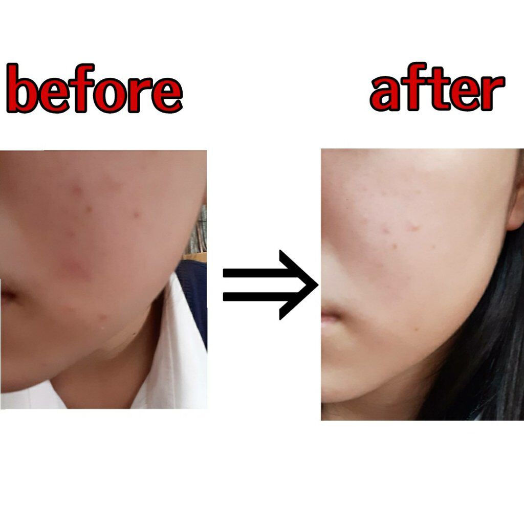 オードムーゲ 薬用ローション（ふきとり化粧水）/オードムーゲ/拭き取り化粧水を使ったクチコミ（3枚目）