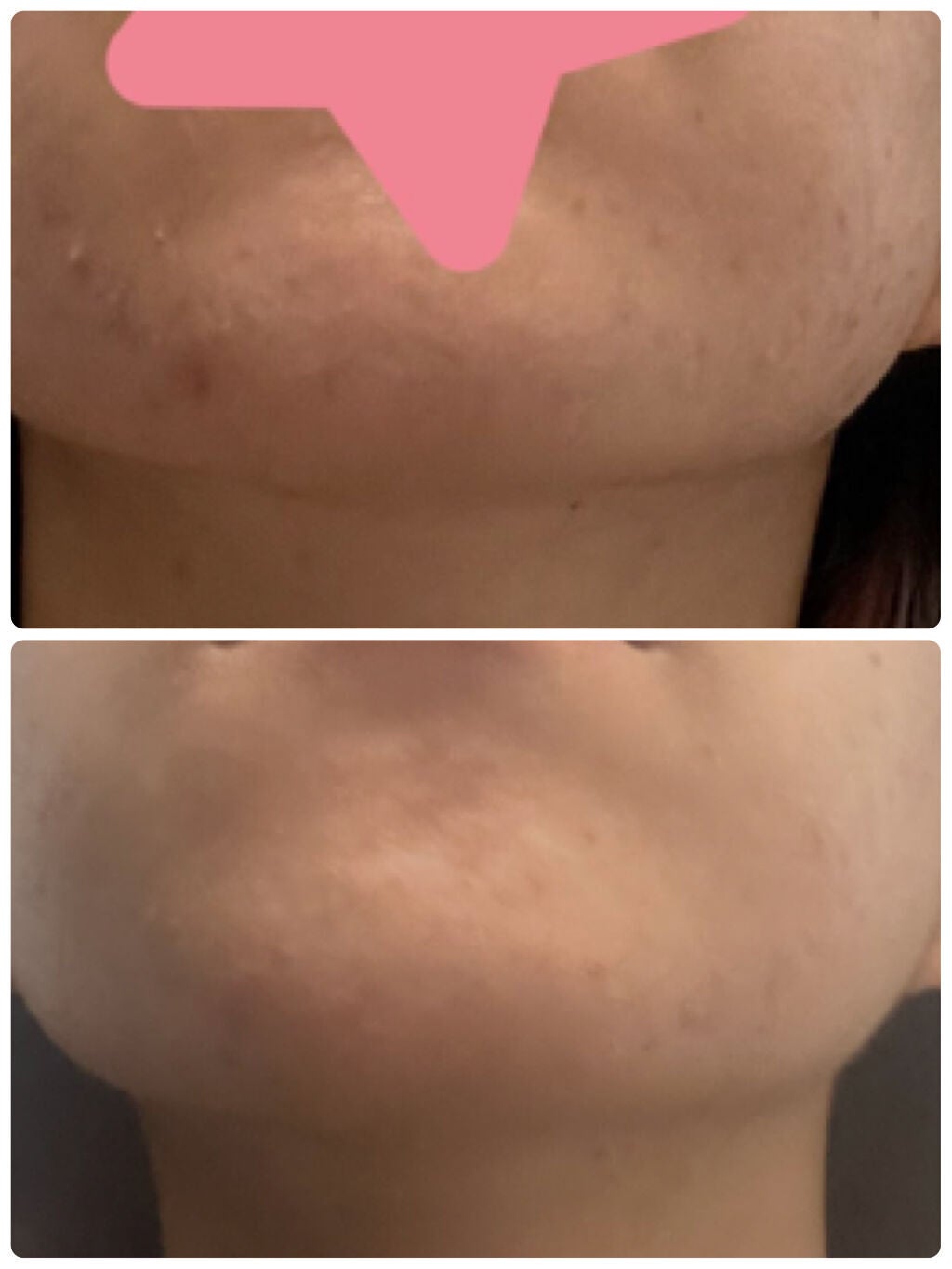 にちか on LIPS 「《使い切りレビュー》 ⚠️2枚目以降閲覧注意ニキビ治療薬 AP..」(4枚目)