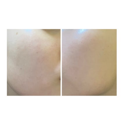 ぽむ on LIPS 「2023.9.13皮膚科に受診 エピデュオとヘパリン処方1枚目..」(5枚目)