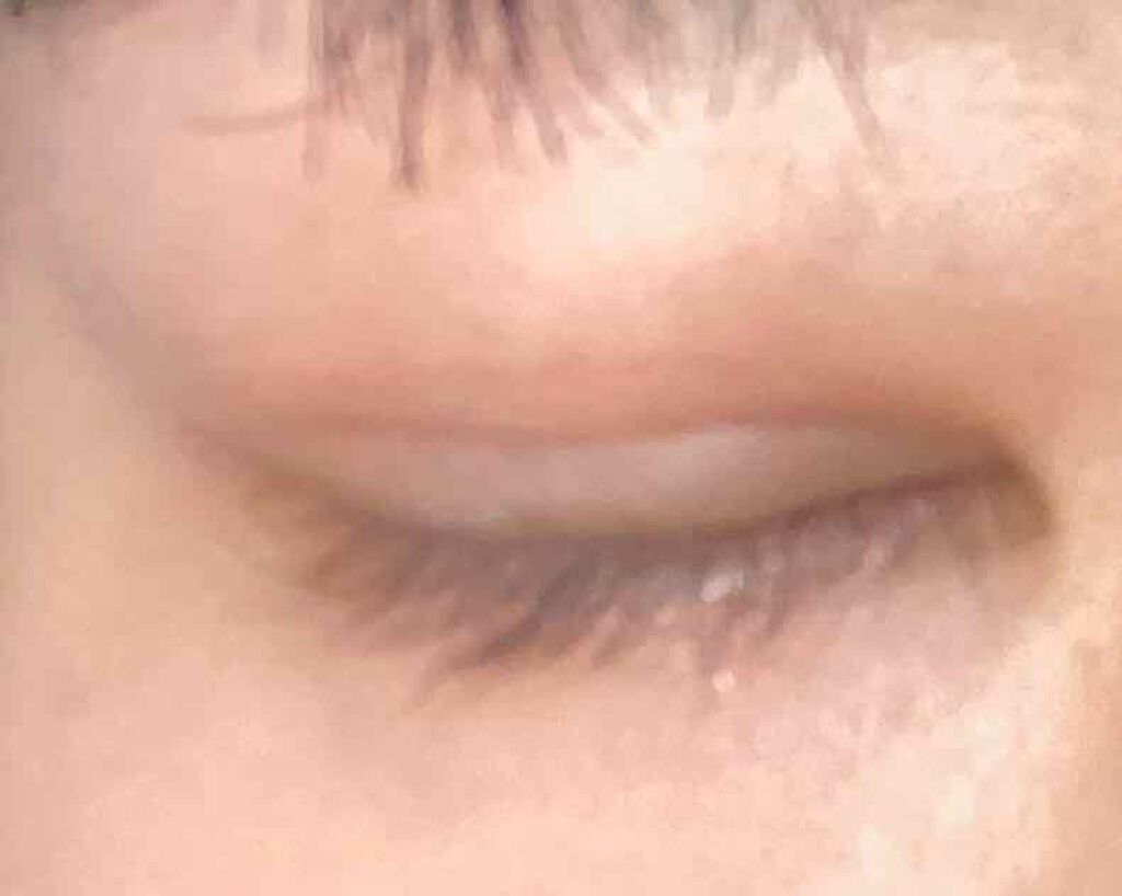 さな on LIPS 「二重整形して1日経ちました。正直違和感と突っ張る痛みはある。翌..」(3枚目)