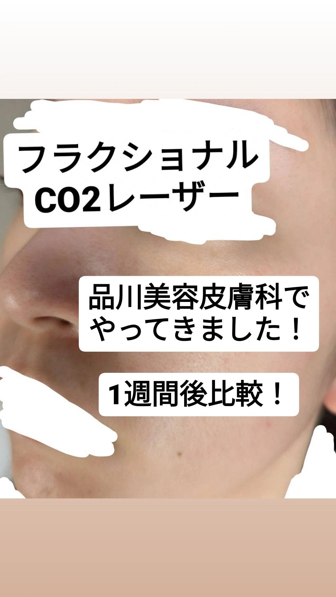 れれ on LIPS 「前情報:顔脱毛は1回しかまだ完了してません品川美容皮膚科でフラ..」(1枚目)