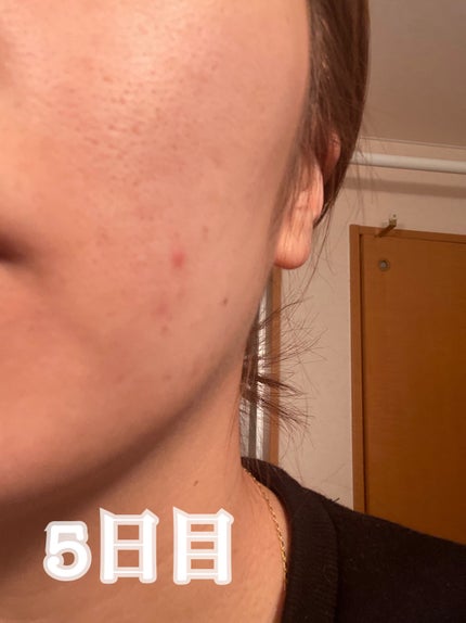 ペアアクネクリームW(医薬品)/ペア/その他を使ったクチコミ(5枚目)