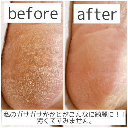 あしやすめ 足裏角質ケアパック/鎌倉ライフ/レッグ・フットケアを使ったクチコミ(3枚目)