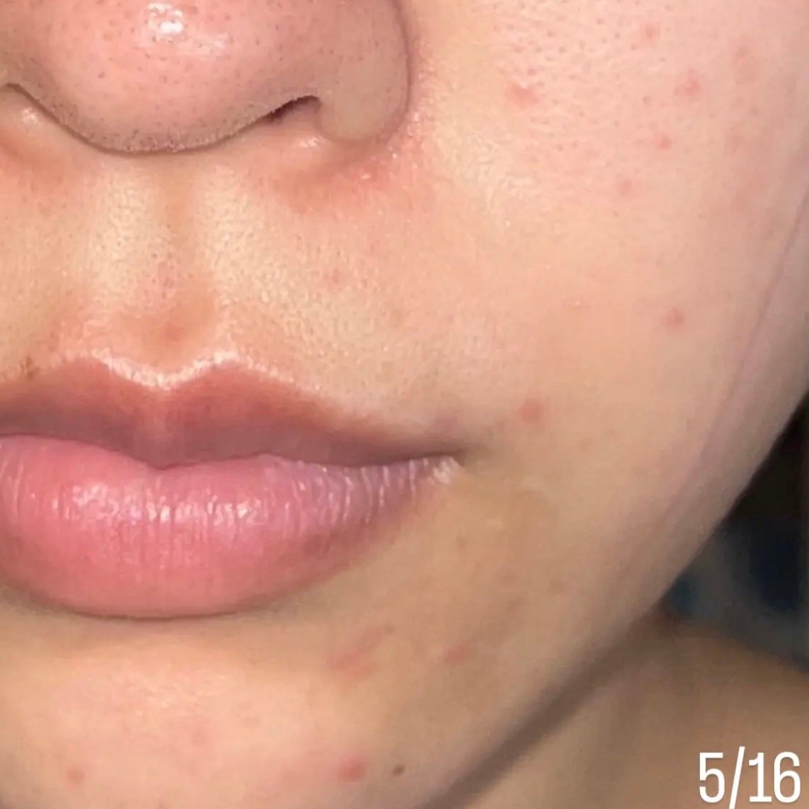 ペアアクネクリームW(医薬品)/ペア/その他を使ったクチコミ(2枚目)