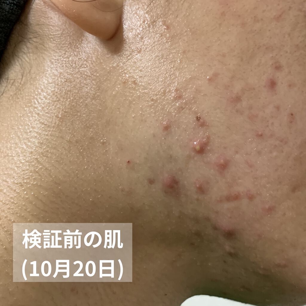 ペアアクネクリームW(医薬品)/ペア/その他を使ったクチコミ（3枚目）