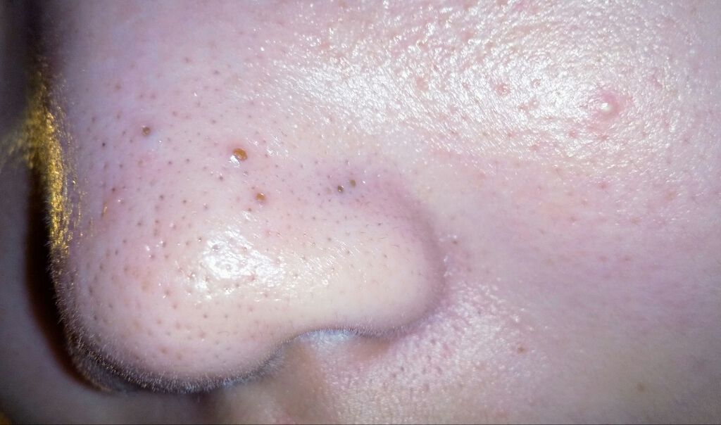 すみれ on LIPS 「助けてください、、、写真を見てわかるように毛穴が本当に酷いんで..」(2枚目)