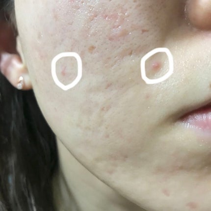 100LAAインパウダー/The Ordinary/その他スキンケアを使ったクチコミ(2枚目)