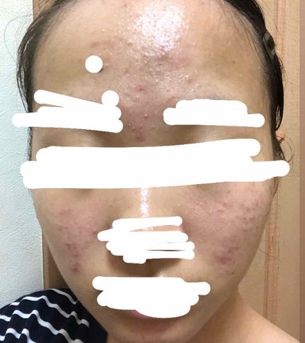 ロゼット洗顔パスタ アクネクリア/ロゼット/洗顔フォームを使ったクチコミ(2枚目)