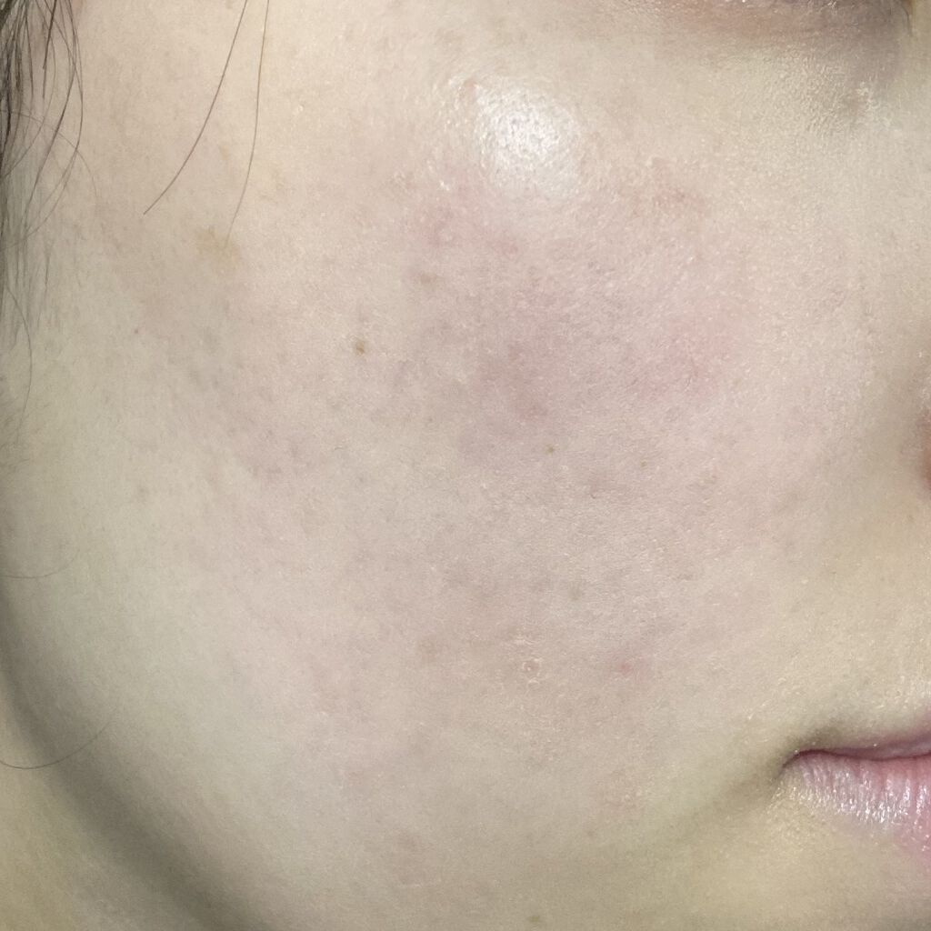 ペアアクネクリームW(医薬品)/ペア/その他を使ったクチコミ（3枚目）