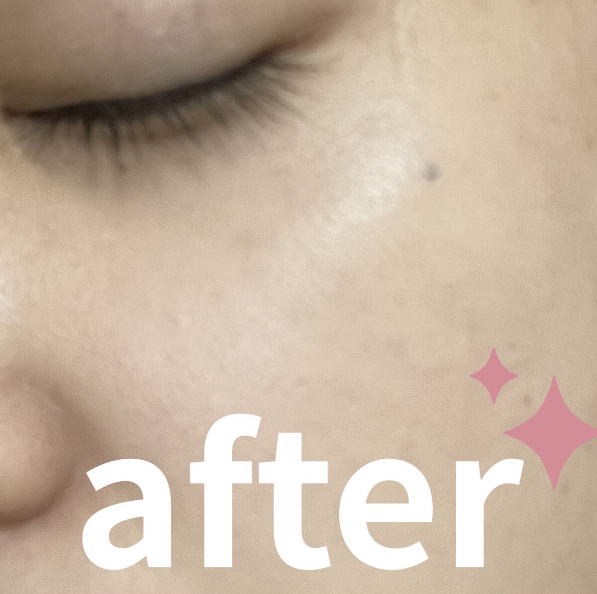 ビッグカバーフィットコンシーラー ニュートラルピーチ/ETUDE/リキッドコンシーラーを使ったクチコミ（2枚目）