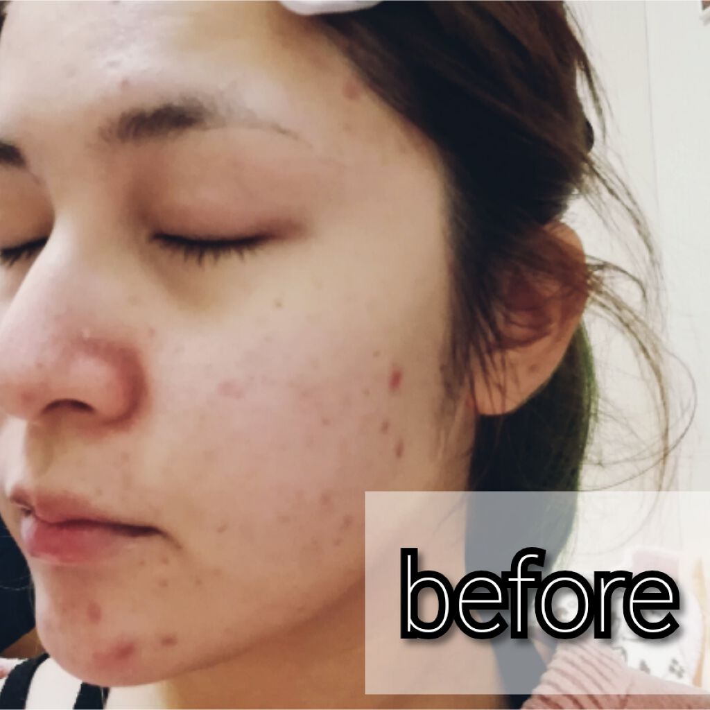 ビーソフテン ローション(医薬品)/持田製薬/その他を使ったクチコミ（2枚目）