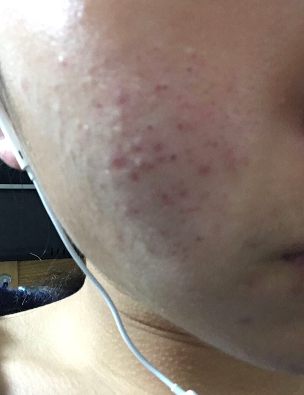 ニキビあとケアジェル/アットノン/その他スキンケアを使ったクチコミ(3枚目)