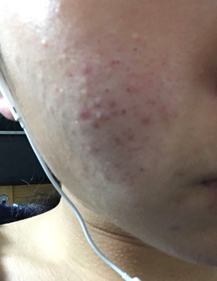 ニキビあとケアジェル/アットノン/その他スキンケアを使ったクチコミ(3枚目)