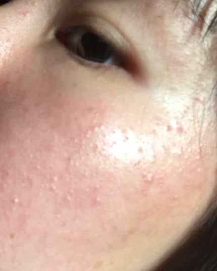 薬用 しみ 集中対策 美容液/メラノCC/美容液を使ったクチコミ(2枚目)