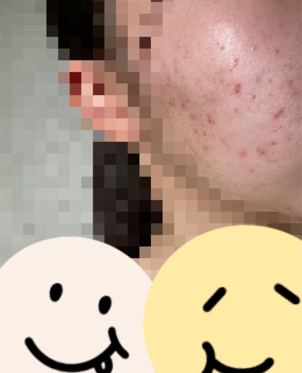 ニキビ治療薬(医薬品)/メンソレータム アクネス/その他を使ったクチコミ(3枚目)