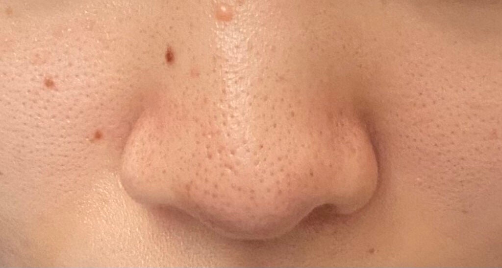 fantastic_blush_vhv on LIPS 「初めまして!現在21歳の女子大生です🐮✏️タイトルの通り、毛穴..」(2枚目)