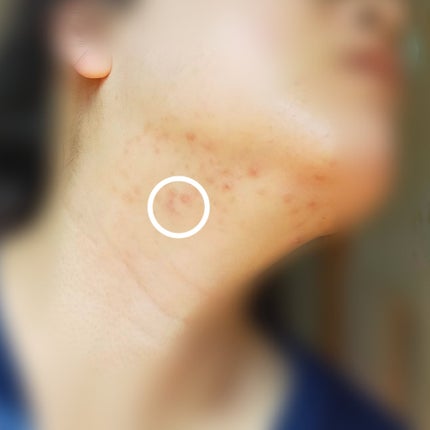 敏感肌な研究者💊あすか💊 on LIPS 「今回は首のニキビを治す最終段階で出来たニキビのそっくりさん(極..」(5枚目)