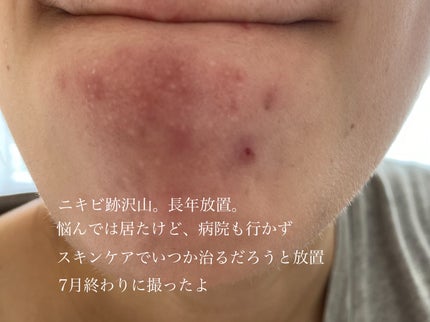 アクネウォッシュ23アンプル/Feld Apotheke/美容液を使ったクチコミ(4枚目)