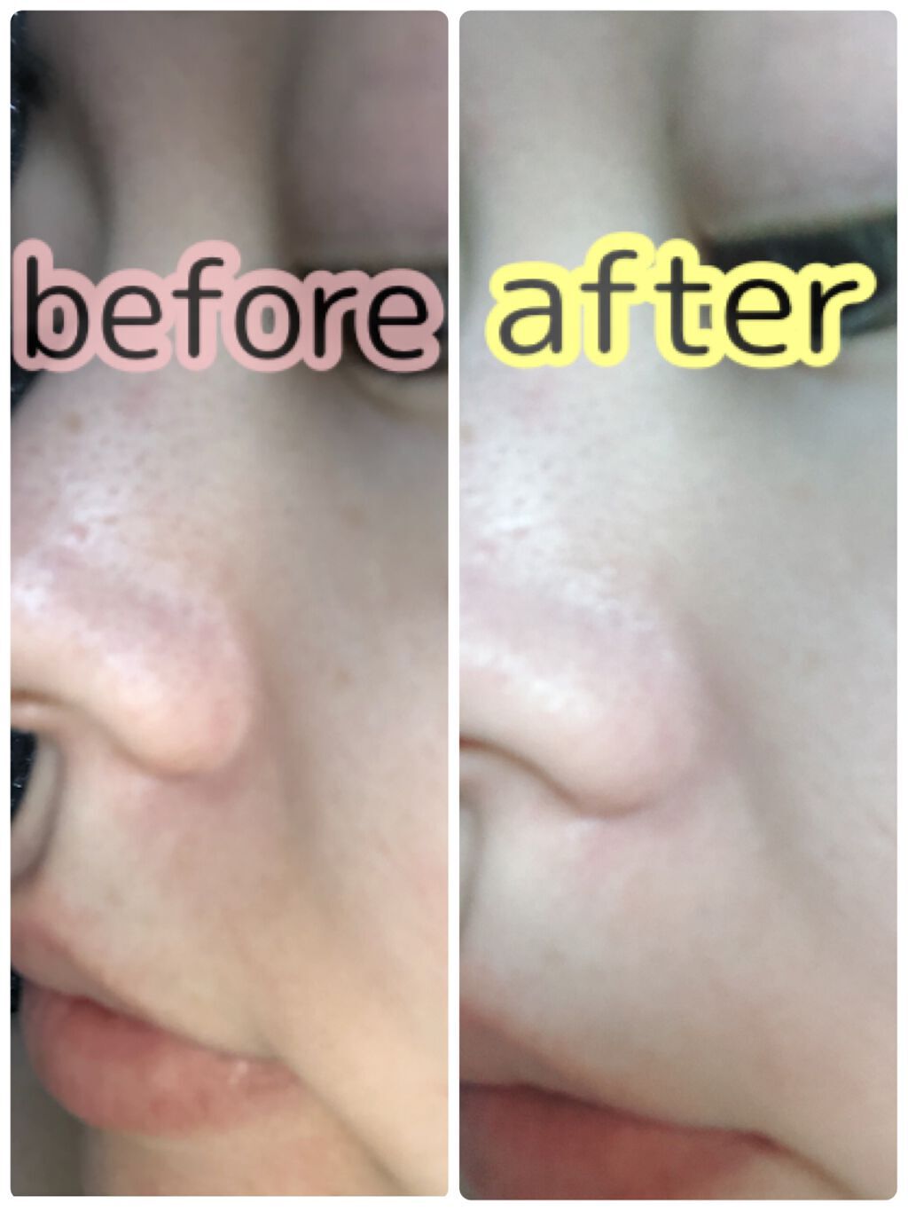 フェイシャルマイルドピーリング/primera/ピーリングを使ったクチコミ(3枚目)