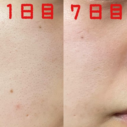 ポアタイトニングアンプルセラム/One-day's you/美容液を使ったクチコミ(7枚目)