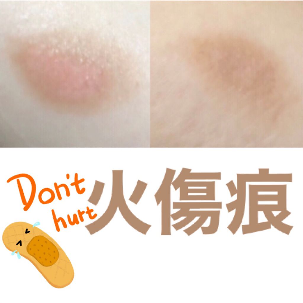 メンソレータム アトキュア 医薬品 ロート製薬の辛口レビュー 腕を火傷してしまい市販の薬を毎日塗り続けた By にきびちゃん 代後半 Lips