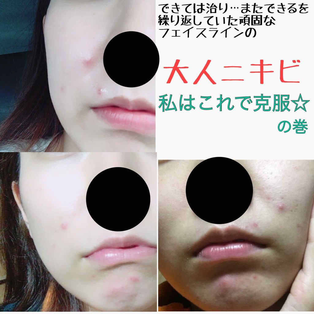 ミルクまんじゅう☆ on LIPS 「20代になってから悩み続けてきた「「大人ニキビ」」様々なニキビ..」(1枚目)