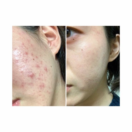 皮脂トラブルケア 化粧水/キュレル/化粧水を使ったクチコミ(1枚目)