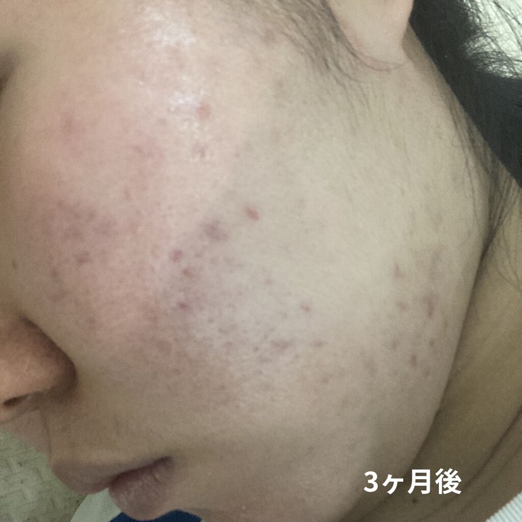 ニキビあとケアジェル/アットノン/その他スキンケアを使ったクチコミ（3枚目）