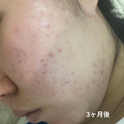 ニキビあとケアジェル/アットノン/その他スキンケアを使ったクチコミ(3枚目)