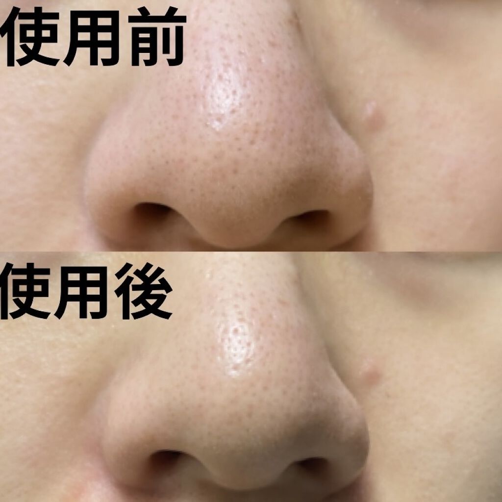 メディヒール ソクソクノーズパック Medihealの使い方を徹底解説 イチゴ鼻とさよなら Medihealの毛 By Misora Scosme 毎日投稿 混合肌 代前半 Lips