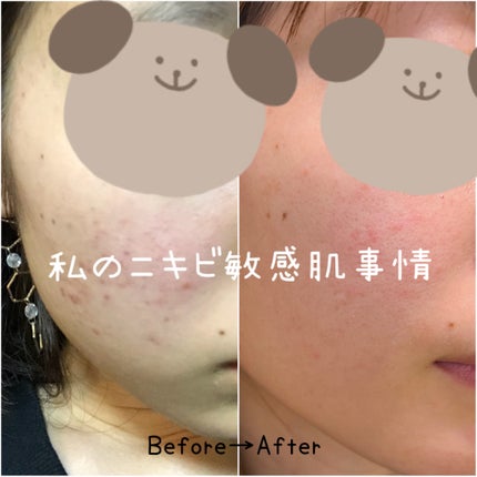 オードムーゲ 薬用ローション(ふきとり化粧水)/オードムーゲ/拭き取り化粧水を使ったクチコミ(1枚目)