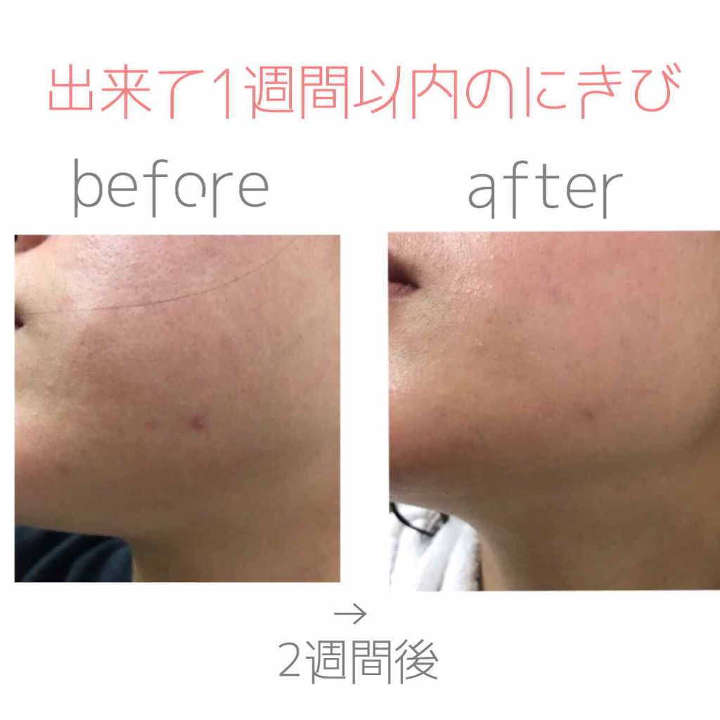 バイオイル/バイオイル/フェイスオイルを使ったクチコミ(3枚目)