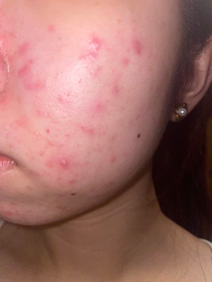 モイストバランス ローション/ACSEINE/化粧水を使ったクチコミ(2枚目)