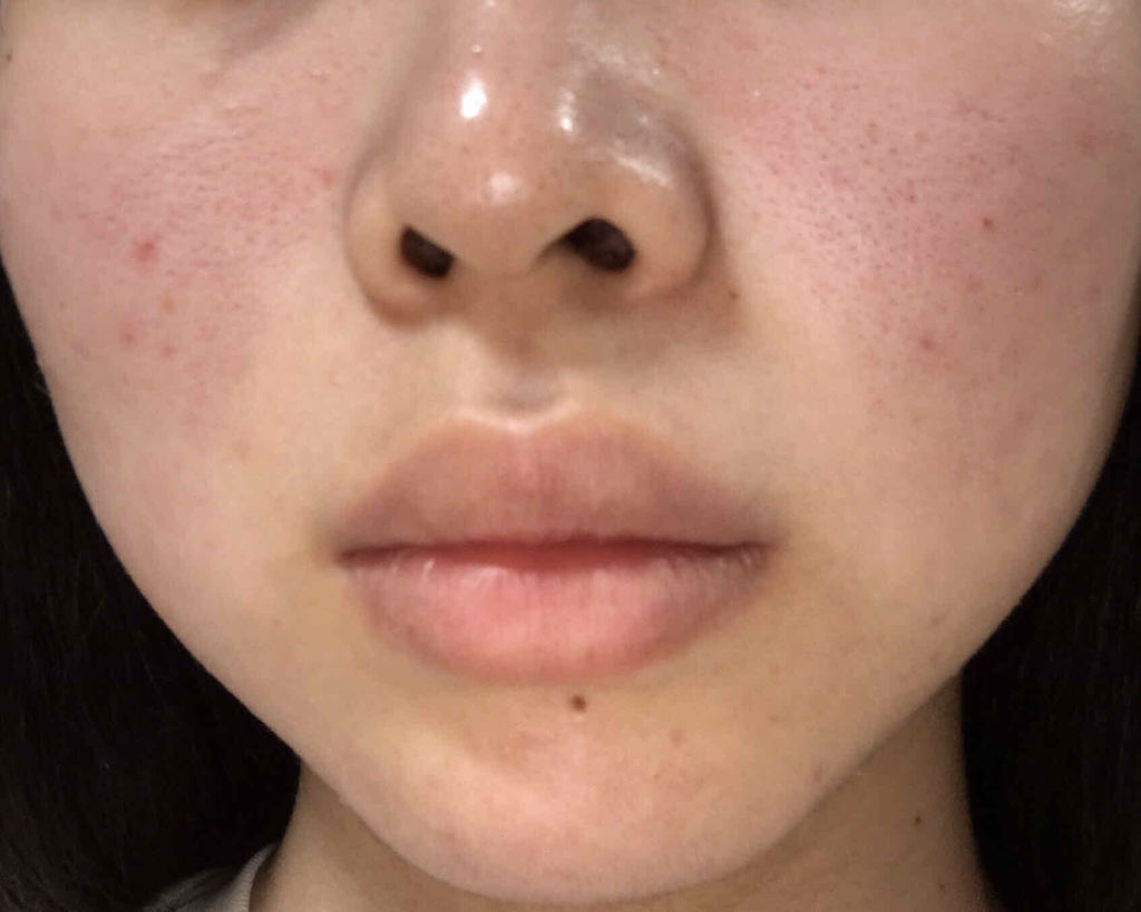 薬用保湿化粧水/オードムーゲ/化粧水を使ったクチコミ（1枚目）