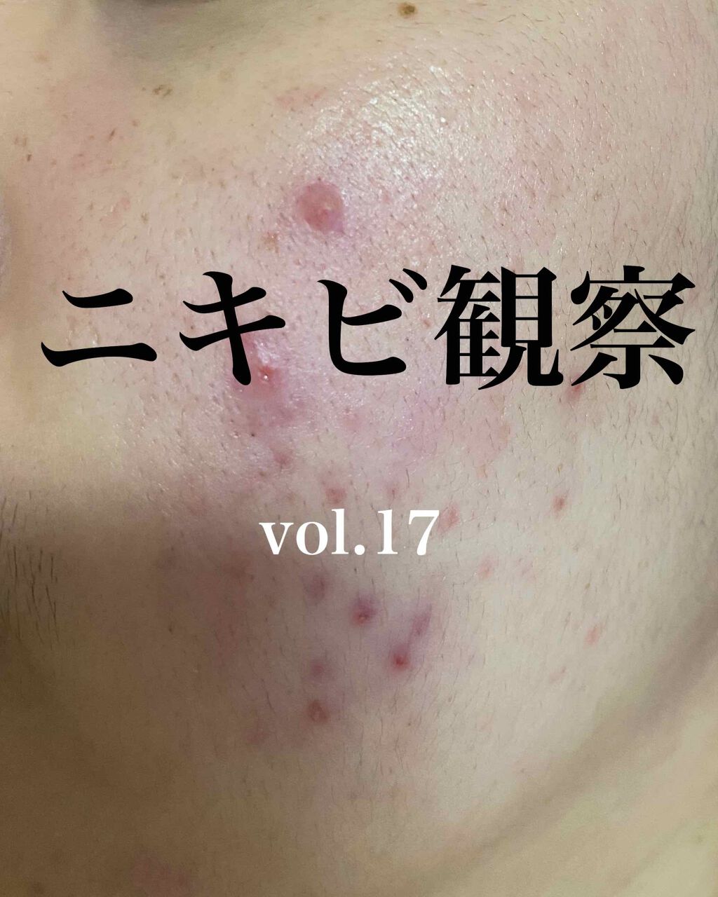 ACC パッチ/ETUDE/シートマスク・パックを使ったクチコミ（1枚目）