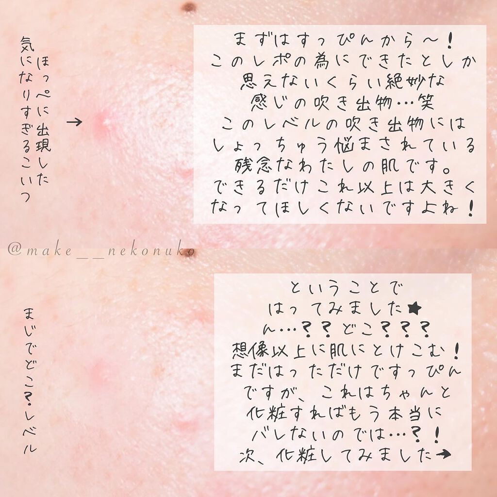 極薄透明パッチ nikipa!/金冠堂/にきびパッチを使ったクチコミ(2枚目)