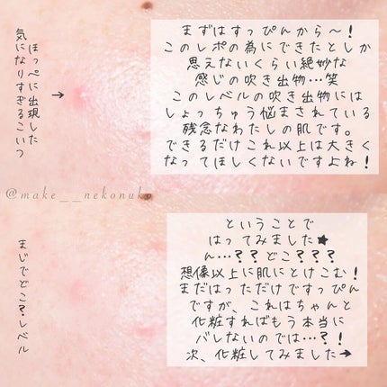 極薄透明パッチ nikipa!/金冠堂/にきびパッチを使ったクチコミ(2枚目)