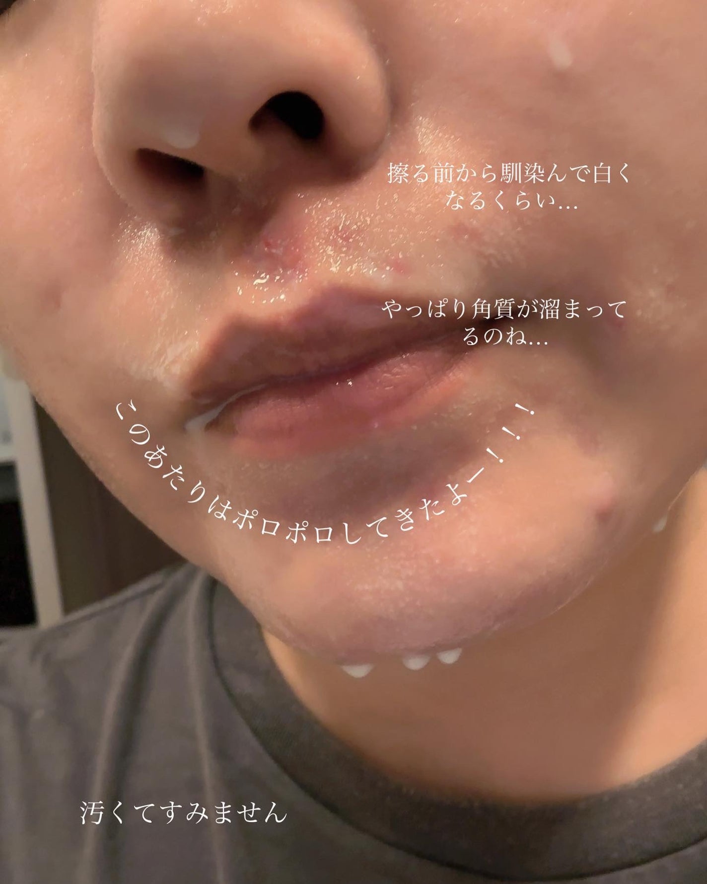 薬用アクネ角質ケアジェル/NIKI PITA/ピーリングを使ったクチコミ(6枚目)