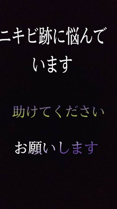 皆さーん、お願いします！私をニキビ跡の沼から助けてください！！

こんにちはー。りこっちです。
皆さんは、1度は悩んだことのあるニキビ、そしてその後にやってくる最大の壁！！ニキビ跡！！

私は、もう小5