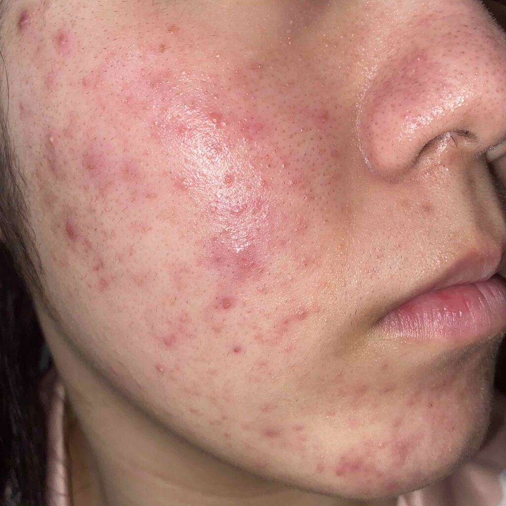 ぴろ on LIPS 「ニキビ撲滅日記を5/25~始めました🔥25日に始めようとしたん..」(2枚目)