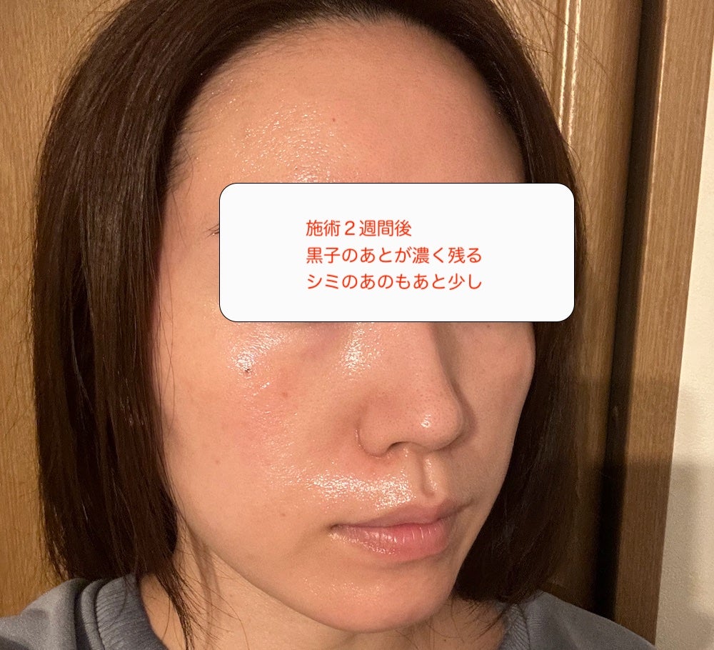 minaㅋㅋㅋ on LIPS 「韓国ソウル江南にある【you&i美容クリニック】にてシミ取り施..」(9枚目)