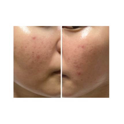 ぽむ on LIPS 「2023.9.13皮膚科に受診 エピデュオとヘパリン処方1枚目..」(4枚目)