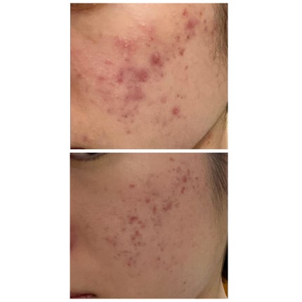 ディフェリンゲル0.1% /マルホ株式会社/その他を使ったクチコミ(3枚目)