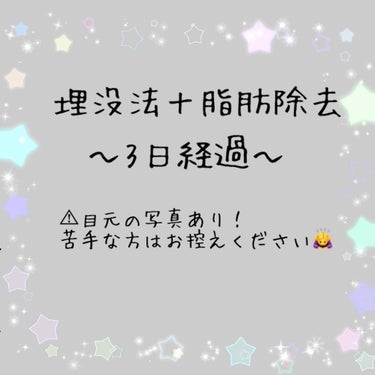 埋没法＋脂肪除去をして3日経過しました。
大きな変化は特にありませんでしたが、今日は痒みが出てきました。

見た目の変化があまりないので、少し様子を見てみて 変化が現れたら再度投稿しようと思います！

