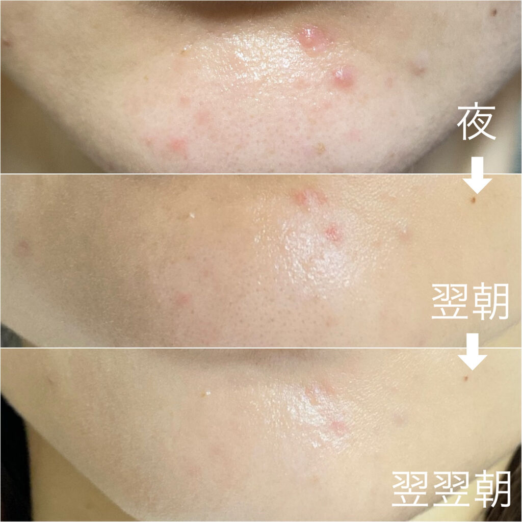 ドクダミ 77 スージングトナー/Anua/化粧水を使ったクチコミ（3枚目）