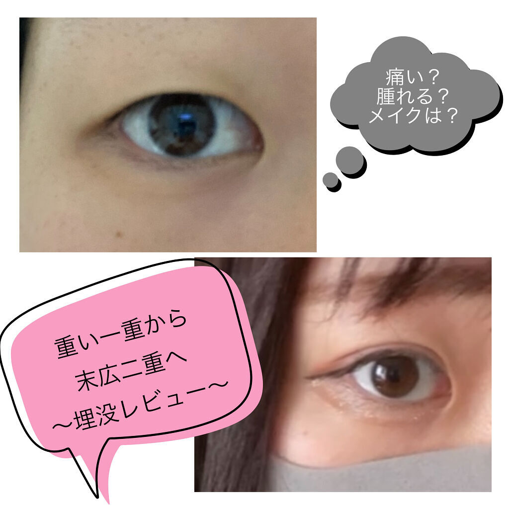 二重整形/その他を使ったクチコミ（1枚目）